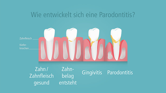 Zahnfleischbluten, die bösen Bakterien, wir erklären Parodontologie und Zusammenhänge mit Herz-, Kreislauferkrankungen