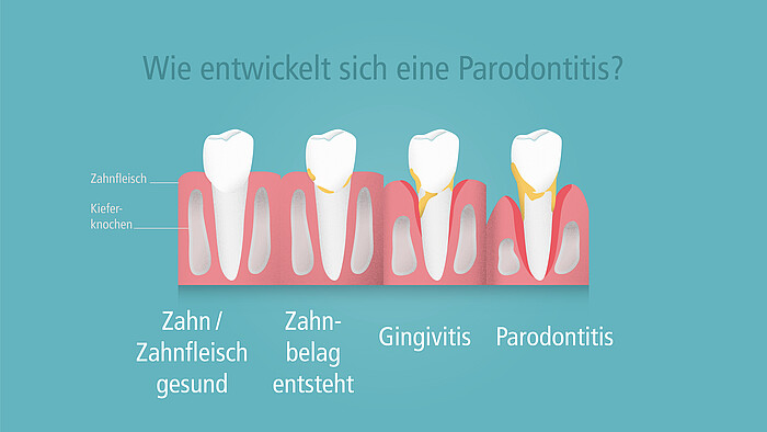 Parodontologie (Erkrankungen des Zahnfleisches)